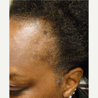 58 yr old female with 2 treatments, using Qilib as well. before 3517862