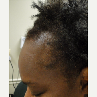 58 yr old female with 2 treatments, using Qilib as well. after 3517862