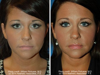Neck Liposuction before 1389715