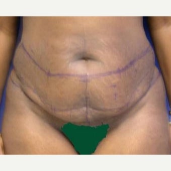 45-54 year old woman treated with Tummy Tuck and Liposuction before 1860351