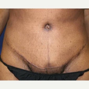 45-54 year old woman treated with Tummy Tuck and Liposuction after 1860351