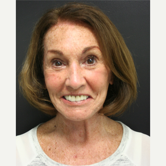 65-74 year old woman treated with SMAS Facelift after 3405796