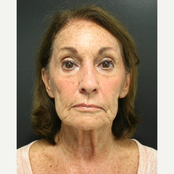 65-74 year old woman treated with SMAS Facelift before 3405796