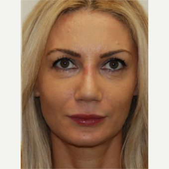 35-44 year old woman treated with Rhinoplasty after 3388016