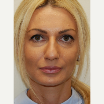 35-44 year old woman treated with Rhinoplasty before 3388016