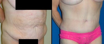 Tummy Tuck before 3037940