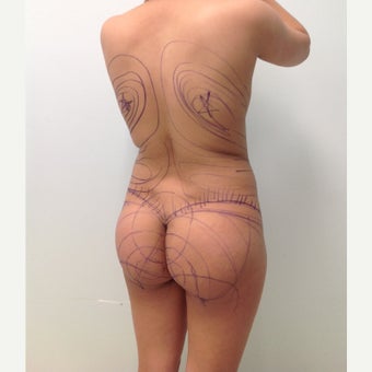 18-24 year old woman treated with Brazilian Butt Lift Revision before 1908879
