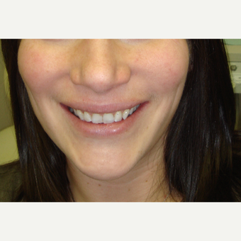 25-34 year old woman treated with Gum Lift after 3638362