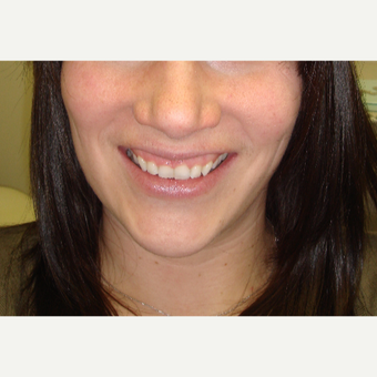 25-34 year old woman treated with Gum Lift before 3638362