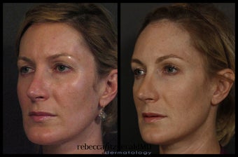 Sculptra for Volume and Contouring before 317027