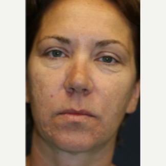 43 year old woman treated with Restylane Silk before 3665001