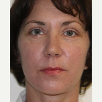 43 year old woman treated with Restylane Silk after 3665001