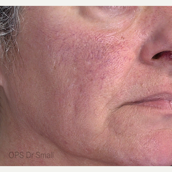 45-54 year old woman treated with V Beam before 3305902