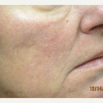 45-54 year old woman treated with V Beam after 3305902