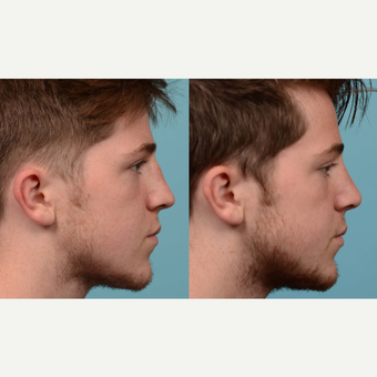 18-24 year old man treated with Rhinoplasty/Septoplasty after 3041964