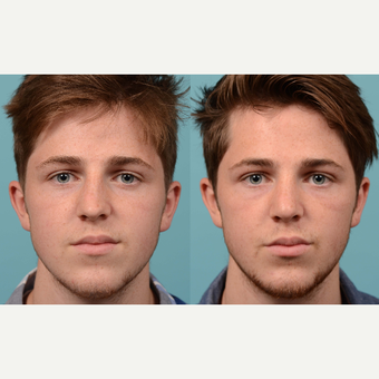 18-24 year old man treated with Rhinoplasty/Septoplasty before 3041964
