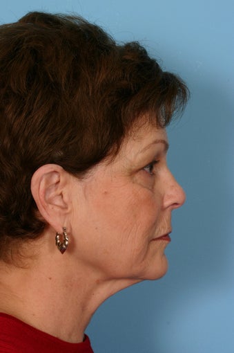 Lower facelift, upper blepharoplasty and facial rejuvenation before 86356