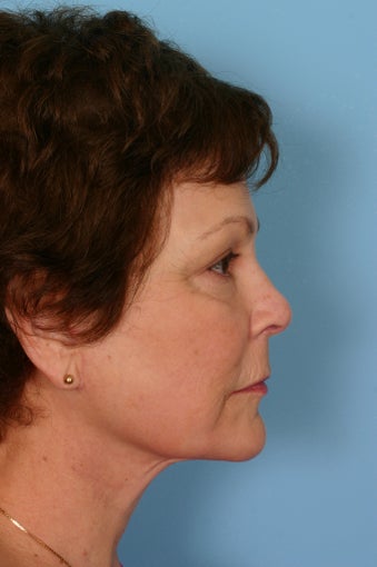 Lower facelift, upper blepharoplasty and facial rejuvenation after 86356