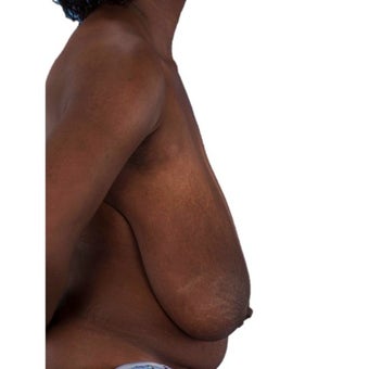45-54 year old woman treated with Breast Reduction 1935383