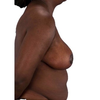 45-54 year old woman treated with Breast Reduction 1935383