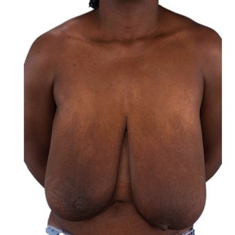 45-54 year old woman treated with Breast Reduction before 1935383
