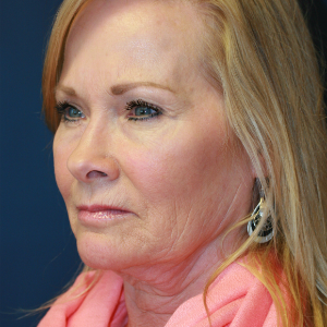 59 year old woman treated with Facelift before 2989623