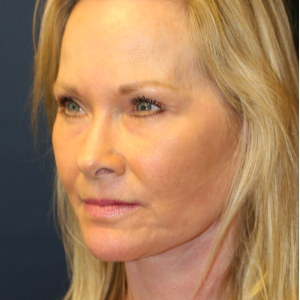 59 year old woman treated with Facelift after 2989623