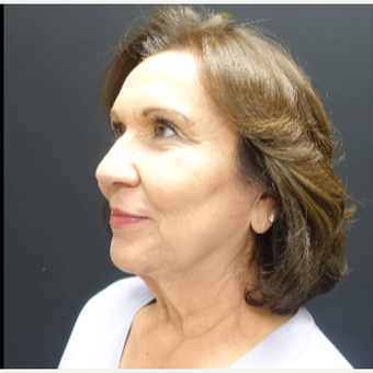 65-74 year old woman treated with Neck Lift before 3244944