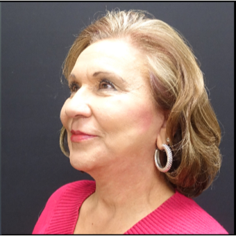 65-74 year old woman treated with Neck Lift after 3244944