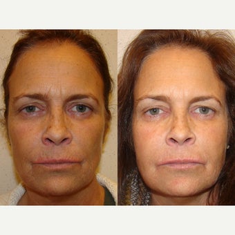 55-64 year old woman treated with Fillers and Botox before 1566206