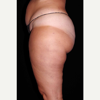 45-54 year old woman treated with Cellulaze after 3280730