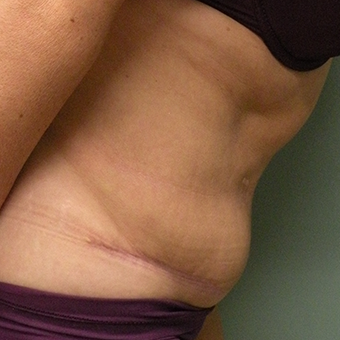45-54 year old woman treated with Tummy Tuck 2873814