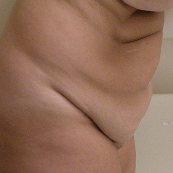 45-54 year old woman treated with Tummy Tuck 2873814