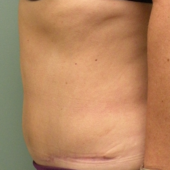 45-54 year old woman treated with Tummy Tuck after 2873814