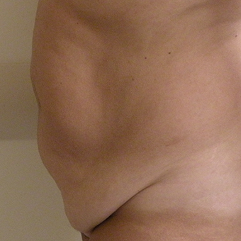 45-54 year old woman treated with Tummy Tuck before 2873814