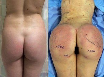 Brazilian Butt Lift in 25 Year Old before 1511886