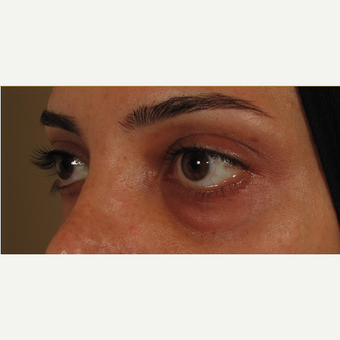 25-34 year old woman treated with Voluma for under eye bags before 3441211