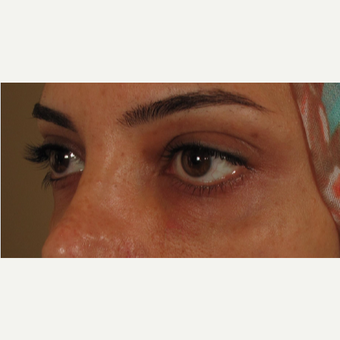25-34 year old woman treated with Voluma for under eye bags after 3441211