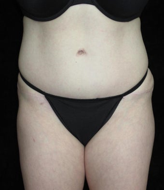 36 year old woman treated with Tummy Tuck after 2637564