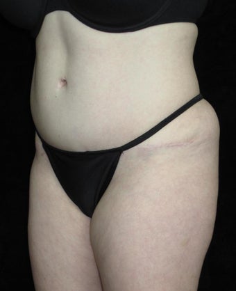 36 year old woman treated with Tummy Tuck 2637564