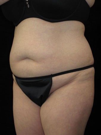 36 year old woman treated with Tummy Tuck 2637564