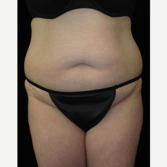 36 year old woman treated with Tummy Tuck before 2637564