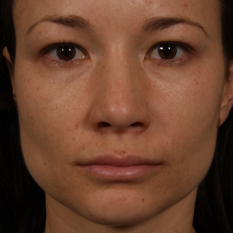 25-34 year old woman treated with Rhinoplasty before 3092346