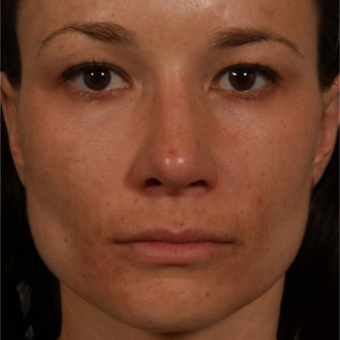 25-34 year old woman treated with Rhinoplasty after 3092346