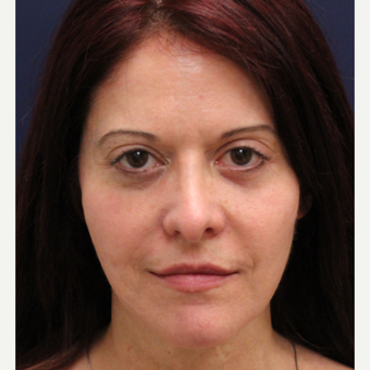 25-34 year old woman treated with Bellafill after 3237157