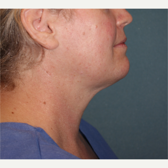 45 year old female 15 years after Neck Liposuction and 40lb weight gain after 3185754
