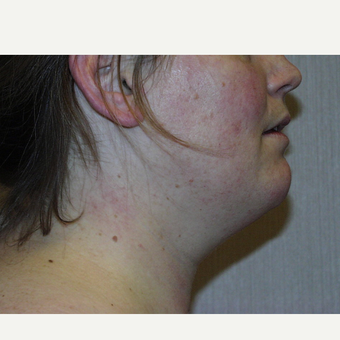 45 year old female 15 years after Neck Liposuction and 40lb weight gain before 3185754