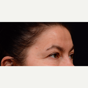 55-64 year old woman treated with Eyelid Surgery before 3776200