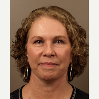 55-64 year old woman treated with Facelift, Restylane to creases between the eyebrows and Dysport after 3031638