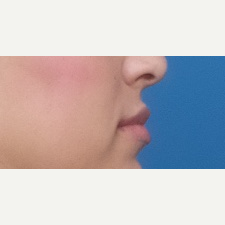 25-34 year old woman treated with Injectable Fillers after 3764280